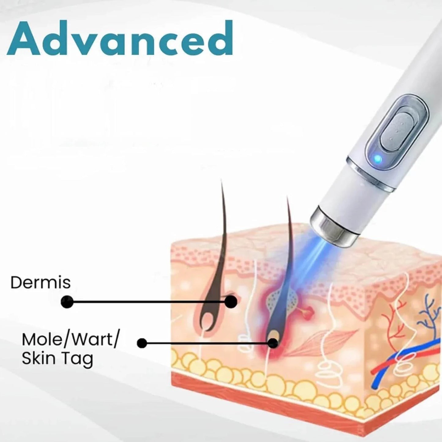 Non-Invasive Mole and Wart Removal Pen