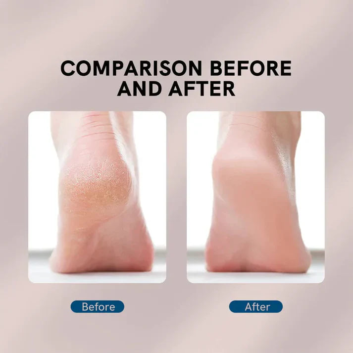 Flawless Electric Foot Callus Remover