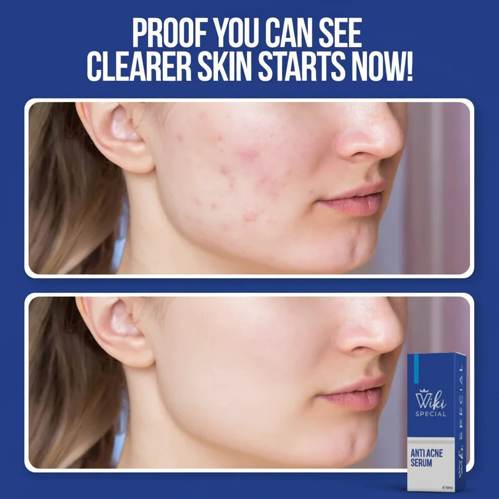 Wiki Special Anti Acne Serum - 30ml