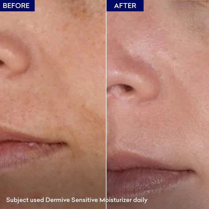 Dermive Sensitive Moisturizer Soothes Skin | Relieves Itching - 100ml