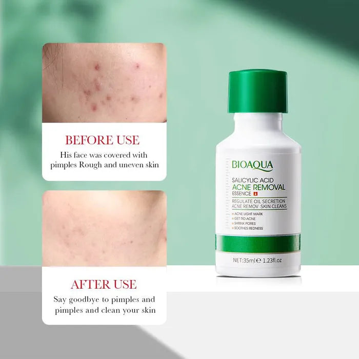 BIOAQUA Salicylic Acid Acne Removal Essence Serum - 35ml | Premium Skincare & Beauty Products in Pakistan