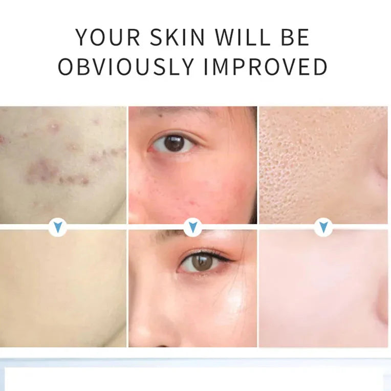 AICHUN BEAUTY  Salicylic Acid Purifying Shrink Pores Exfoliation Anti-Acne Face Serum - 30ml