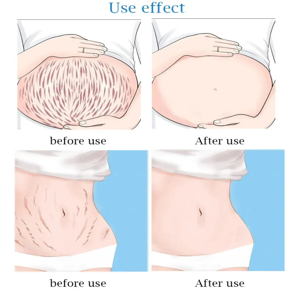 Guanjing Remove Stretch Marks Cream - 80g