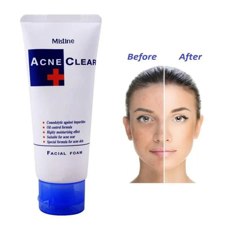 Mistine Acne Clear Facial Foam - 85ml | Premium Skincare & Beauty Products in Pakistan