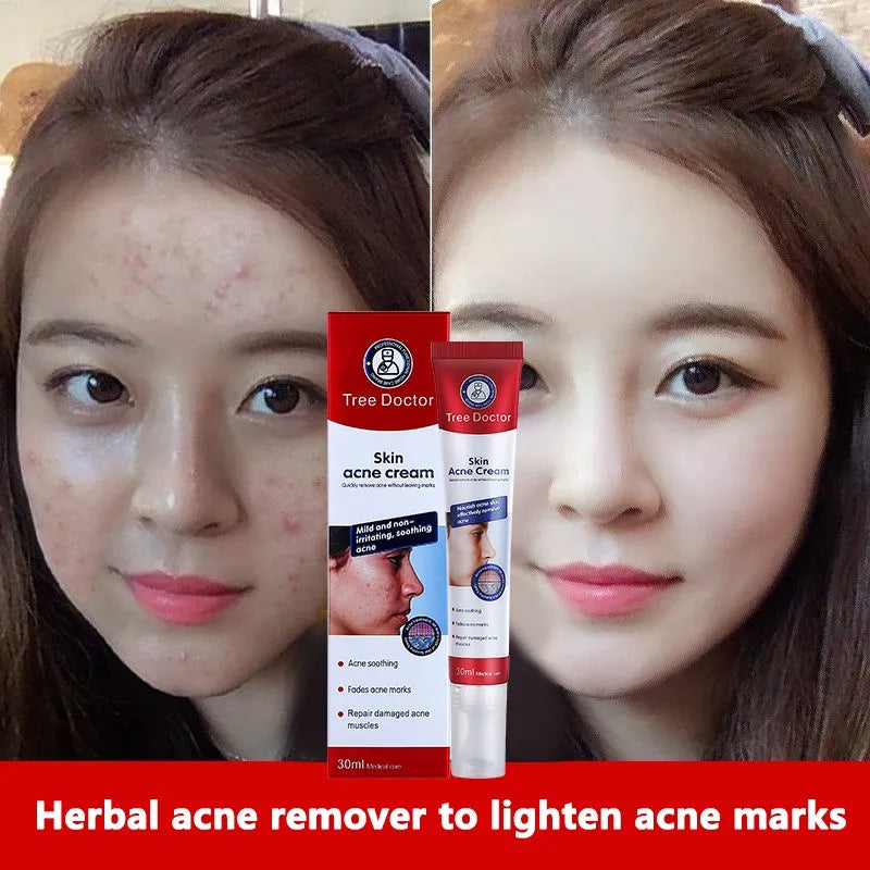Tree Doctor Skin Acne Cream - 30g